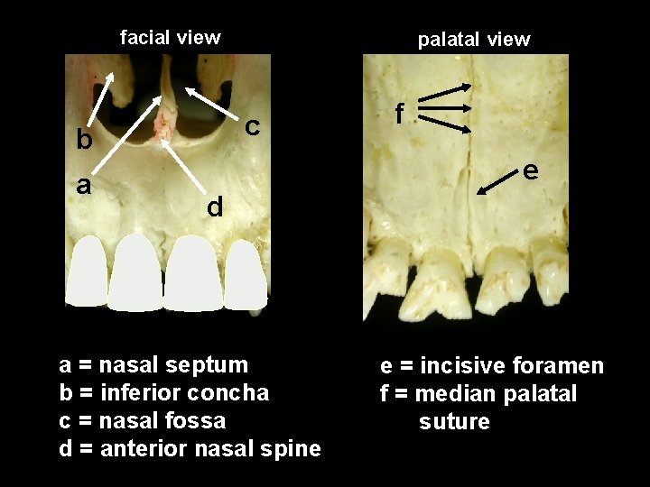 facial view c b a palatal view f e d a = nasal septum