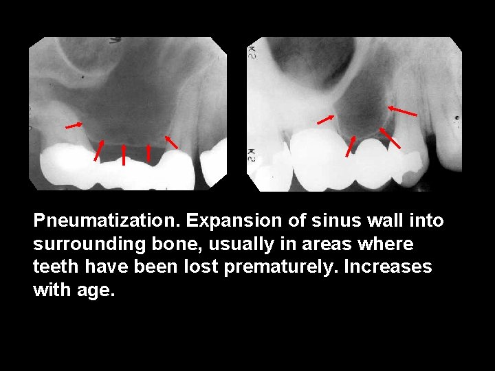 Pneumatization. Expansion of sinus wall into surrounding bone, usually in areas where teeth have