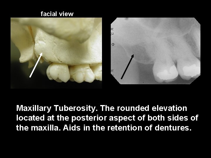 facial view Maxillary Tuberosity. The rounded elevation located at the posterior aspect of both