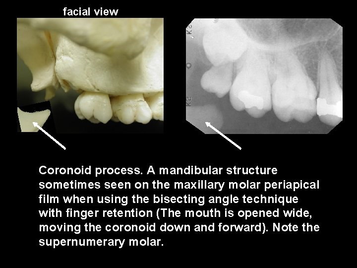 facial view Coronoid process. A mandibular structure sometimes seen on the maxillary molar periapical