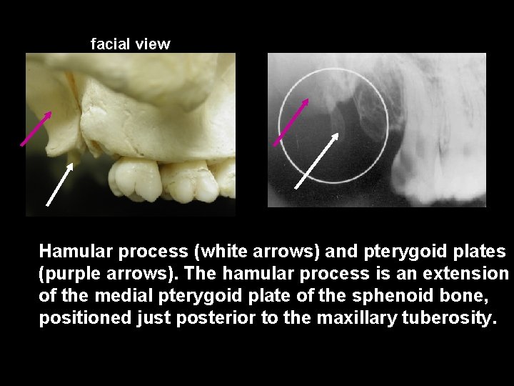 facial view Hamular process (white arrows) and pterygoid plates (purple arrows). The hamular process