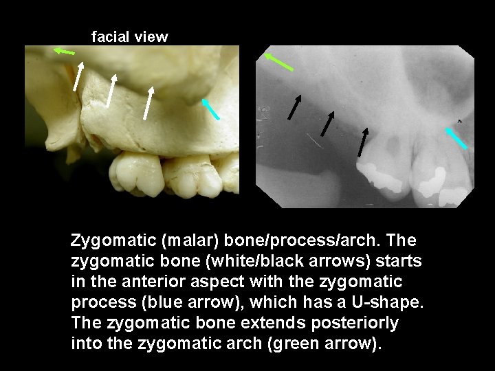 facial view Zygomatic (malar) bone/process/arch. The zygomatic bone (white/black arrows) starts in the anterior