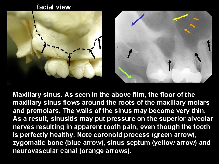 facial view Maxillary sinus. As seen in the above film, the floor of the