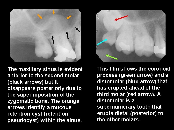 The maxillary sinus is evident anterior to the second molar (black arrows) but it