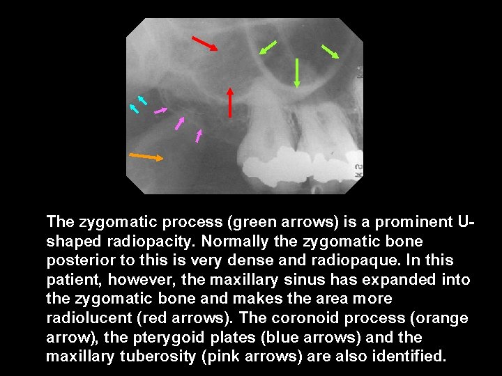 The zygomatic process (green arrows) is a prominent Ushaped radiopacity. Normally the zygomatic bone