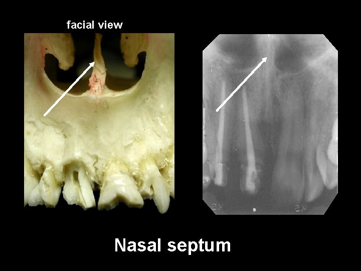 facial view Nasal septum 