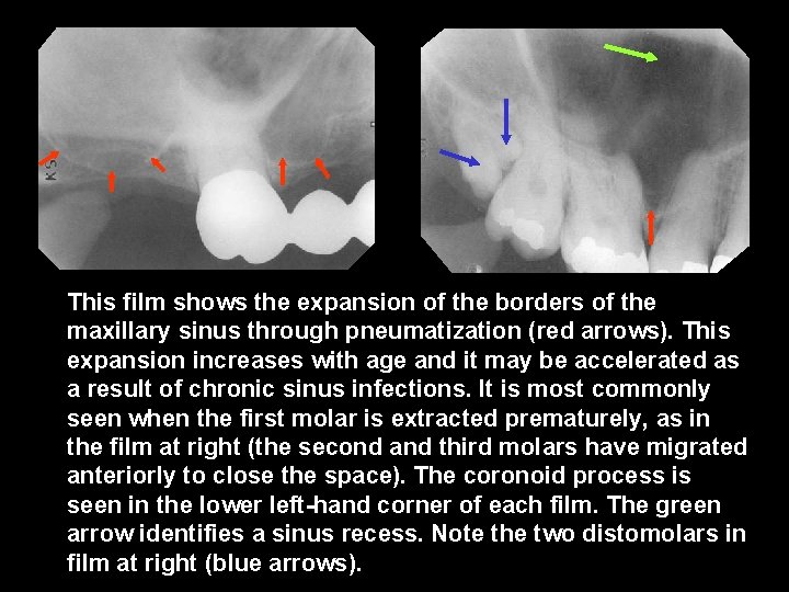 This film shows the expansion of the borders of the maxillary sinus through pneumatization