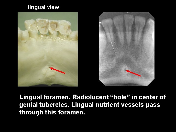 lingual view Lingual foramen. Radiolucent “hole” in center of genial tubercles. Lingual nutrient vessels