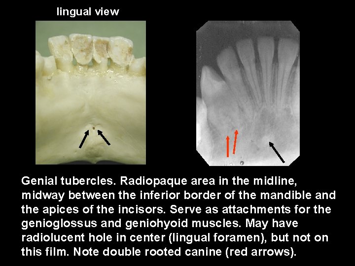 lingual view Genial tubercles. Radiopaque area in the midline, midway between the inferior border