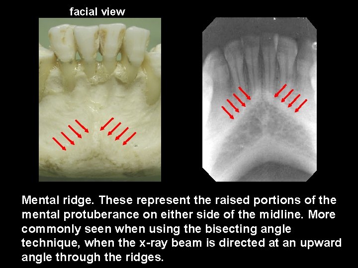 facial view Mental ridge. These represent the raised portions of the mental protuberance on