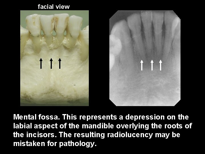 facial view Mental fossa. This represents a depression on the labial aspect of the