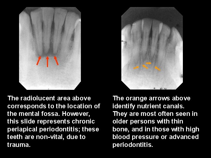 The radiolucent area above corresponds to the location of the mental fossa. However, this