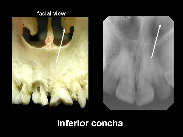 facial view a Inferior concha 