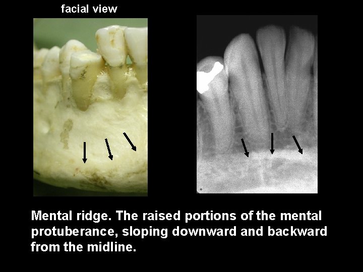 facial view Mental ridge. The raised portions of the mental protuberance, sloping downward and