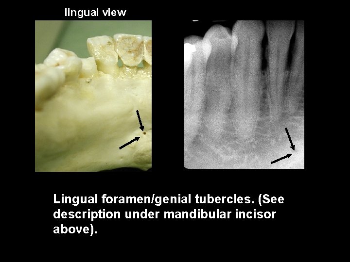 lingual view Lingual foramen/genial tubercles. (See description under mandibular incisor above). 