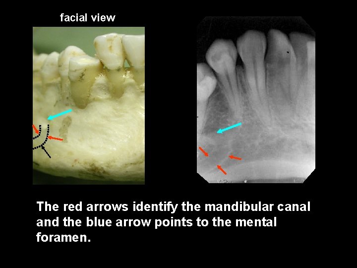 facial view The red arrows identify the mandibular canal and the blue arrow points