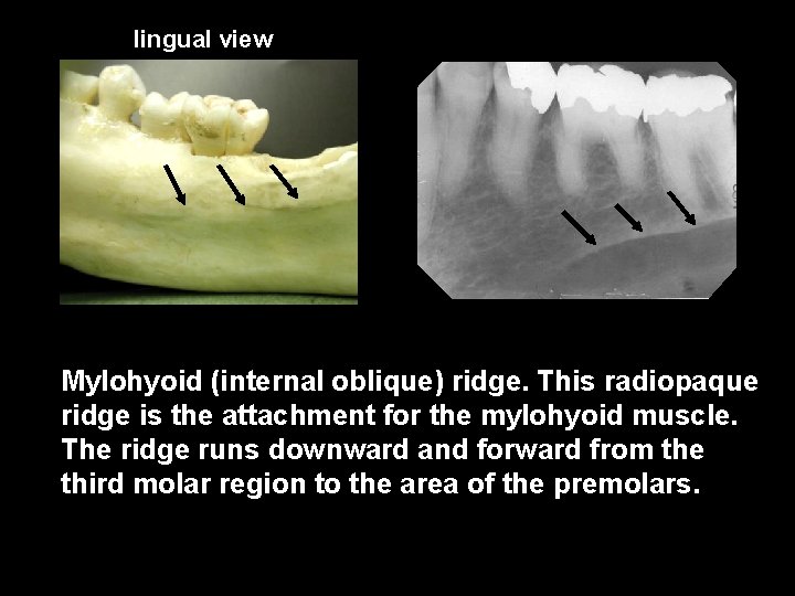 lingual view Mylohyoid (internal oblique) ridge. This radiopaque ridge is the attachment for the