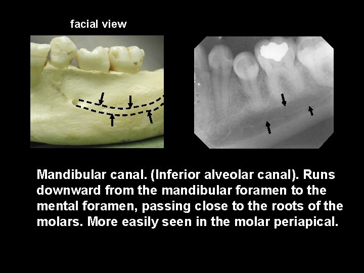 facial view Mandibular canal. (Inferior alveolar canal). Runs downward from the mandibular foramen to