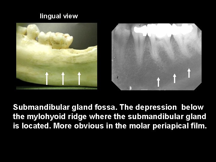 lingual view Submandibular gland fossa. The depression below the mylohyoid ridge where the submandibular