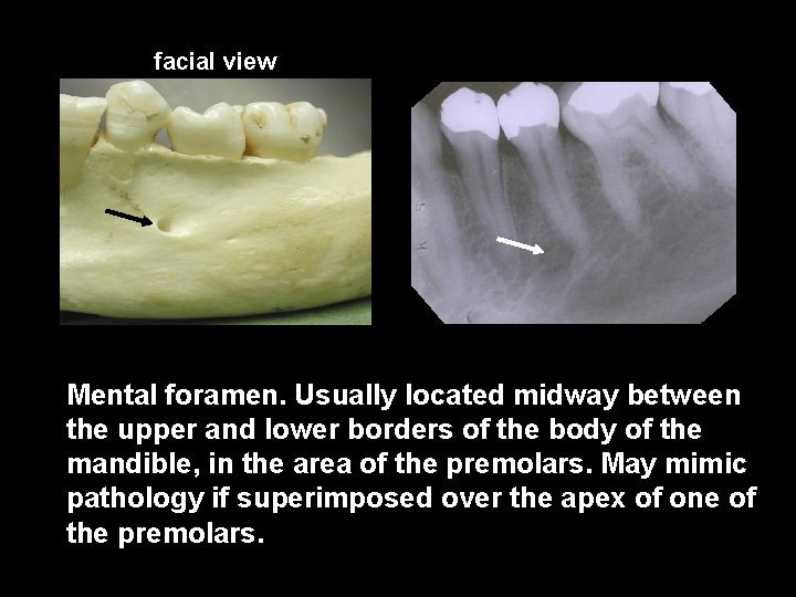facial view Mental foramen. Usually located midway between the upper and lower borders of