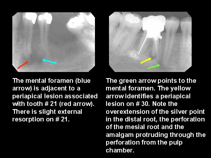 The mental foramen (blue arrow) is adjacent to a periapical lesion associated with tooth