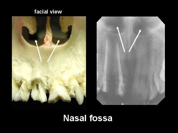 facial view Nasal fossa 