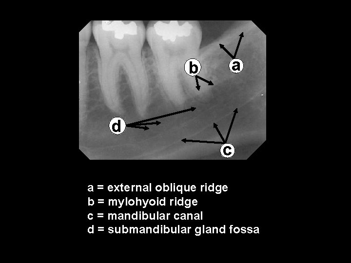 b a d c a = external oblique ridge b = mylohyoid ridge c