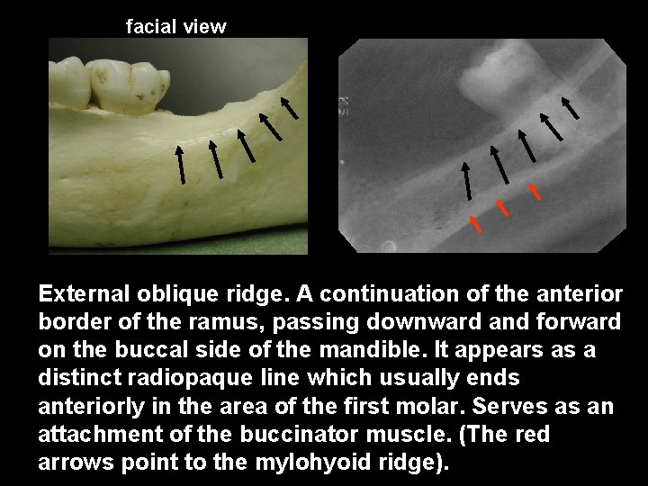 facial view External oblique ridge. A continuation of the anterior border of the ramus,