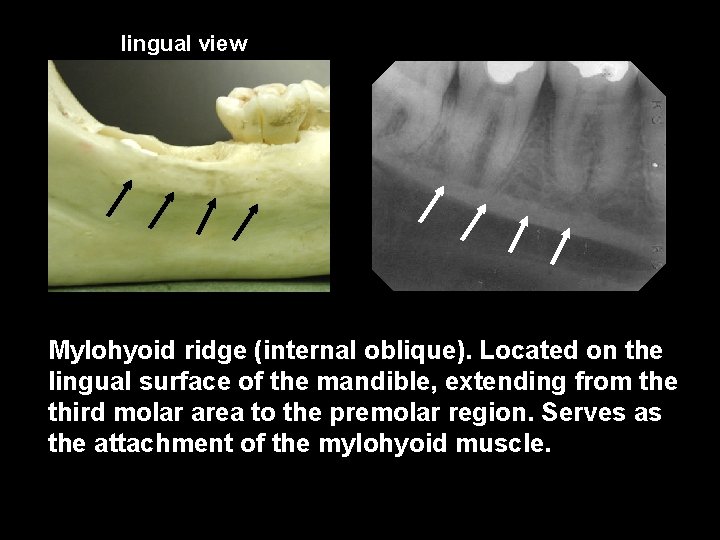 lingual view Mylohyoid ridge (internal oblique). Located on the lingual surface of the mandible,