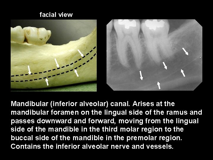 facial view Mandibular (inferior alveolar) canal. Arises at the mandibular foramen on the lingual