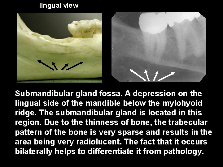 lingual view Submandibular gland fossa. A depression on the lingual side of the mandible