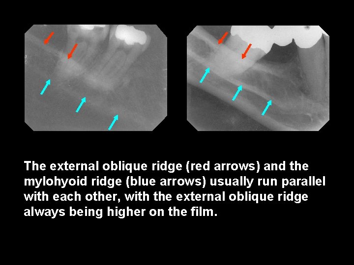 The external oblique ridge (red arrows) and the mylohyoid ridge (blue arrows) usually run
