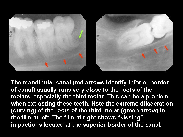 The mandibular canal (red arrows identify inferior border of canal) usually runs very close