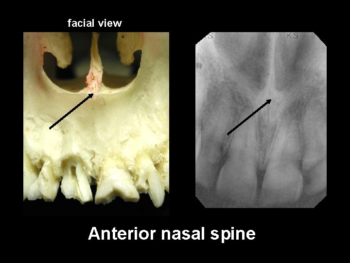 facial view Anterior nasal spine 