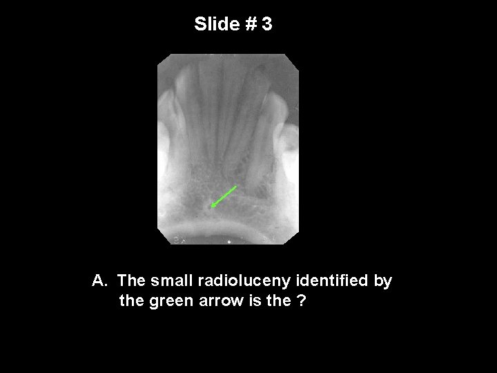 Slide # 3 A. The small radioluceny identified by the green arrow is the