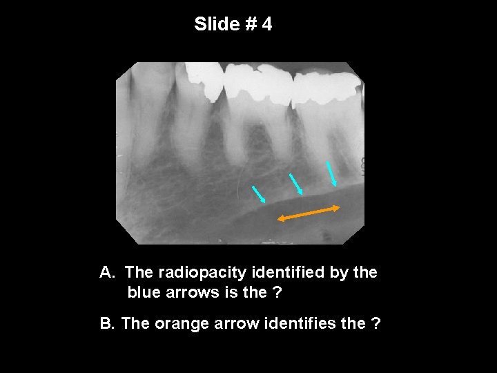 Slide # 4 A. The radiopacity identified by the blue arrows is the ?