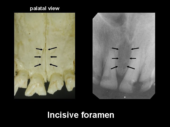 palatal view Incisive foramen 