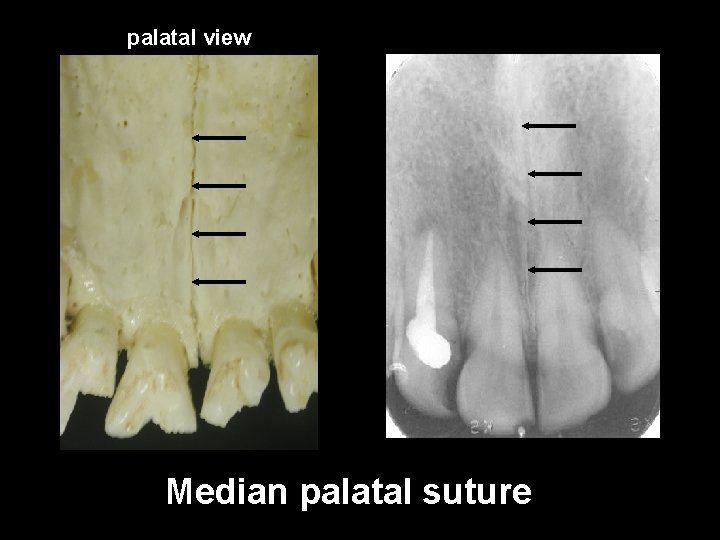 palatal view Median palatal suture 