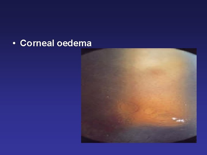  • Corneal oedema 