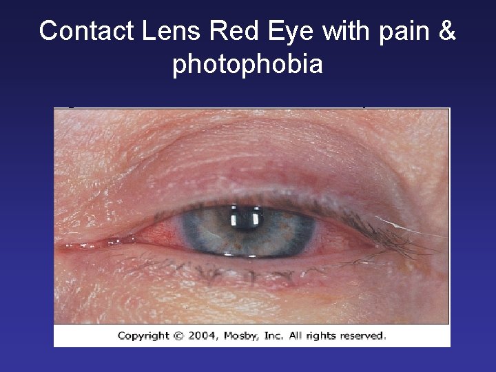 Contact Lens Red Eye with pain & photophobia 