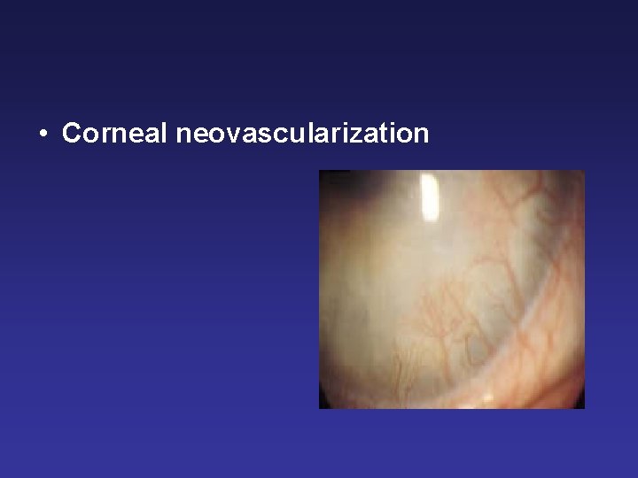  • Corneal neovascularization 