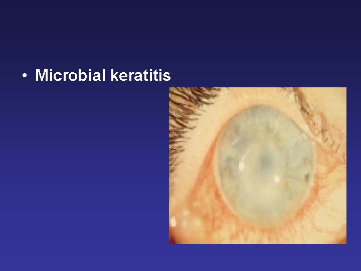  • Microbial keratitis 