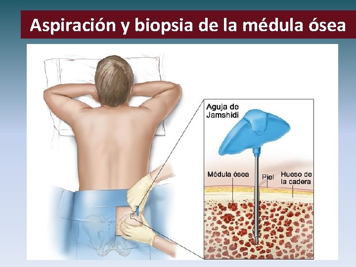 Aspiración y biopsia de la médula ósea 