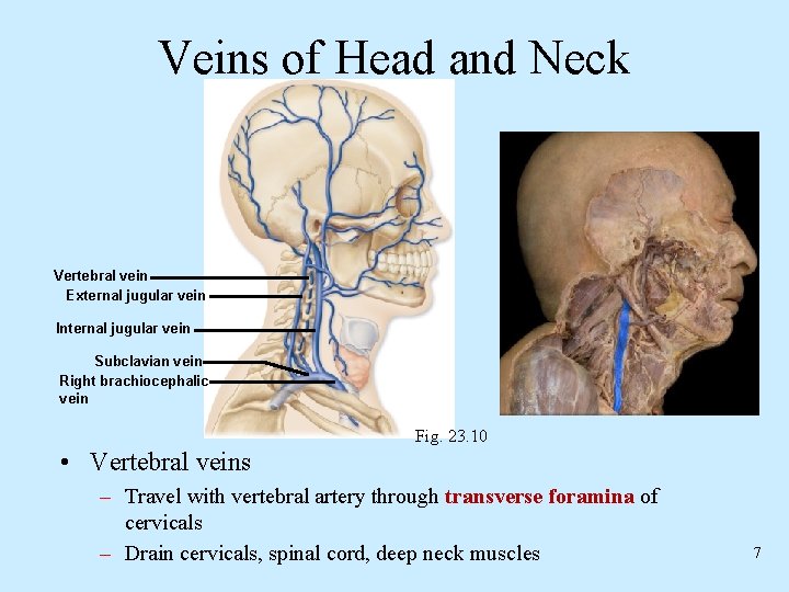 Veins of Head and Neck Vertebral vein External jugular vein Internal jugular vein Subclavian