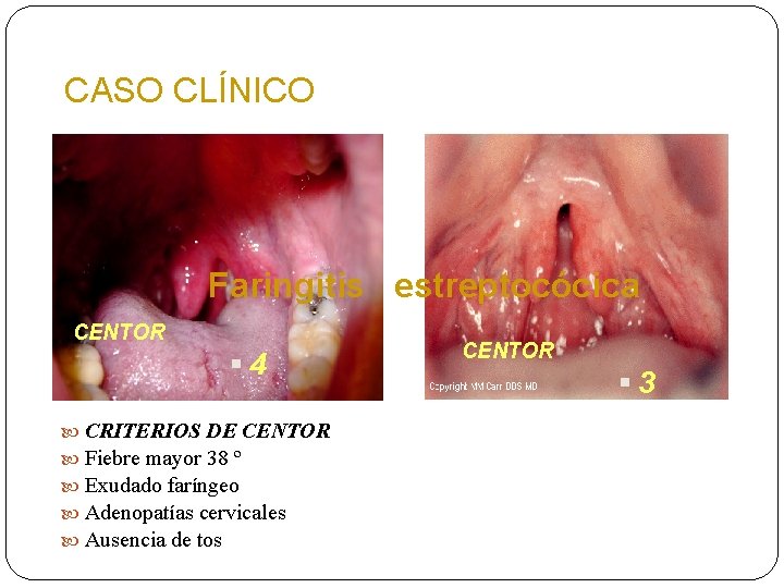 CASO CLÍNICO Faringitis estreptocócica CENTOR § 4 CRITERIOS DE CENTOR Fiebre mayor 38 º