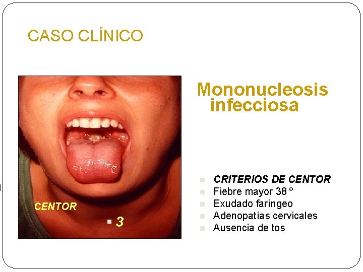 CASO CLÍNICO Mononucleosis infecciosa n n n CENTOR § 3 n n CRITERIOS DE