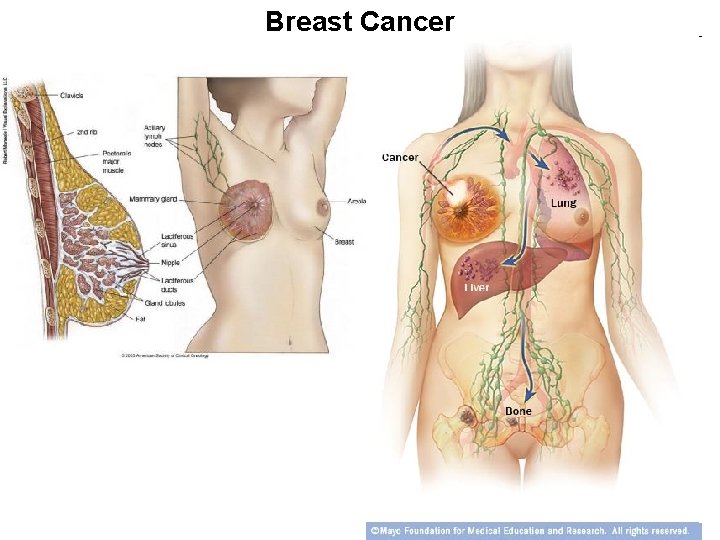 Breast Cancer 