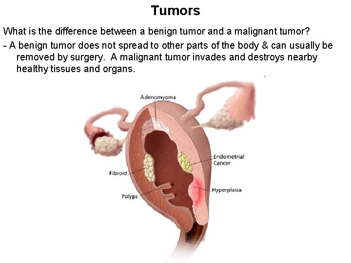 Tumors What is the difference between a benign tumor and a malignant tumor? -