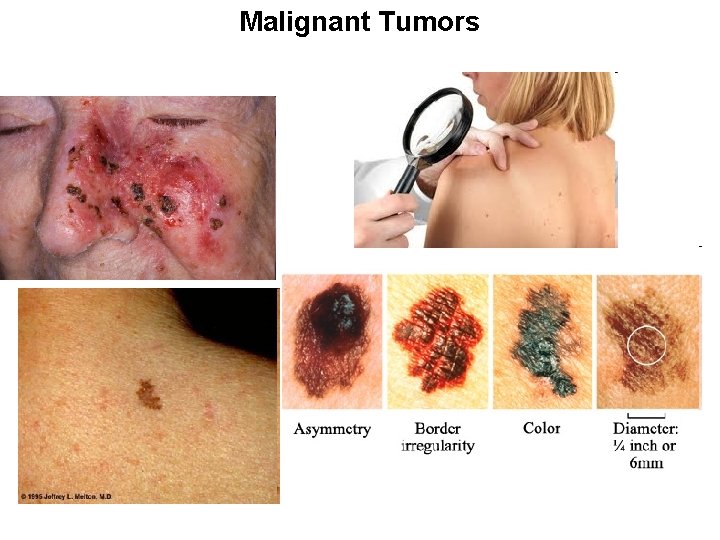 Malignant Tumors 