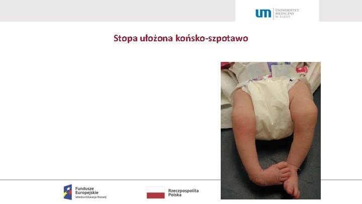 Stopa ułożona końsko-szpotawo 